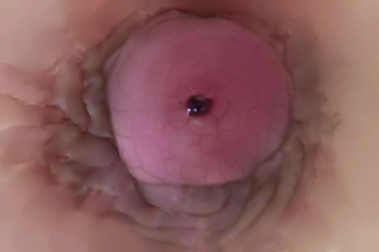 乳腺癌外观图片大全