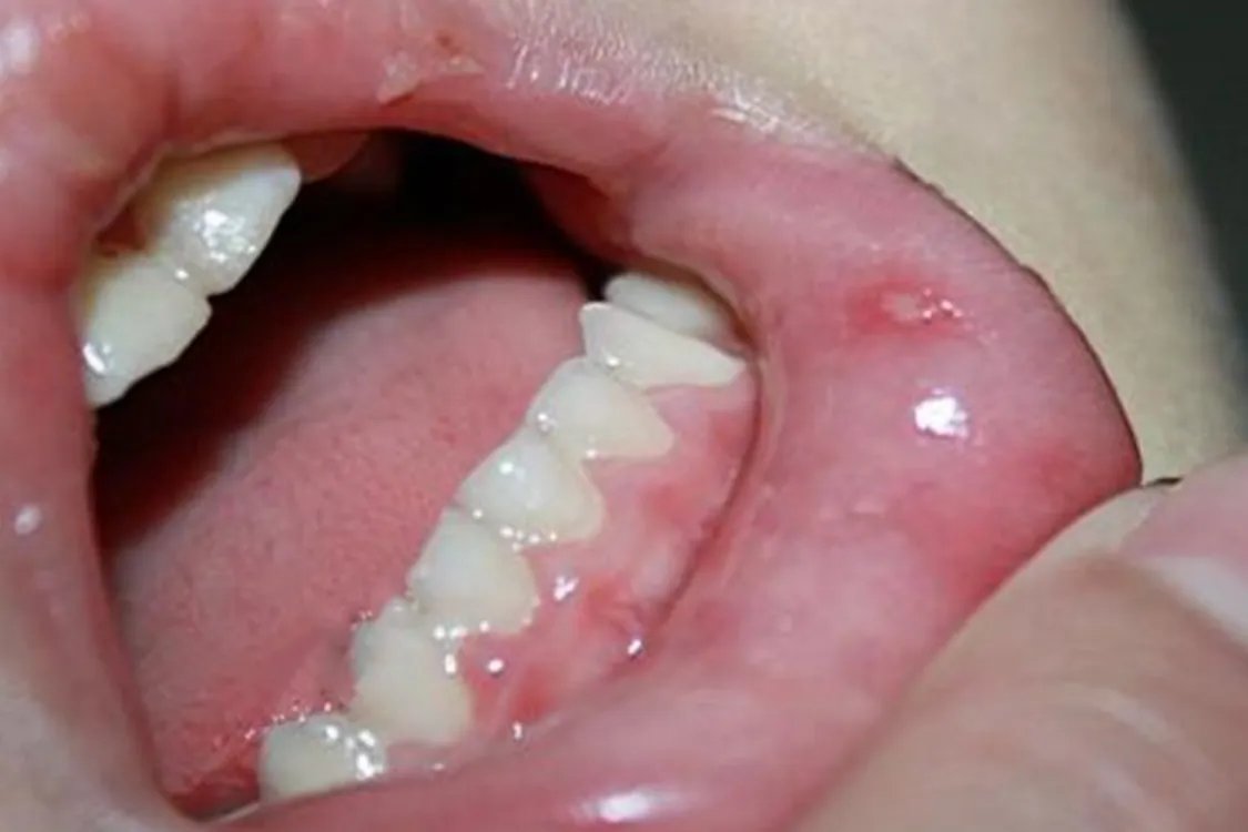 手足口病疹子图片