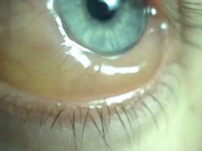 红眼病症状图片