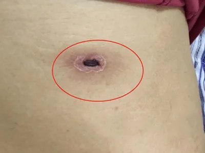 恙虫病焦痂图片