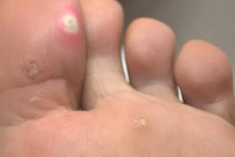 鸡眼图片大全大图