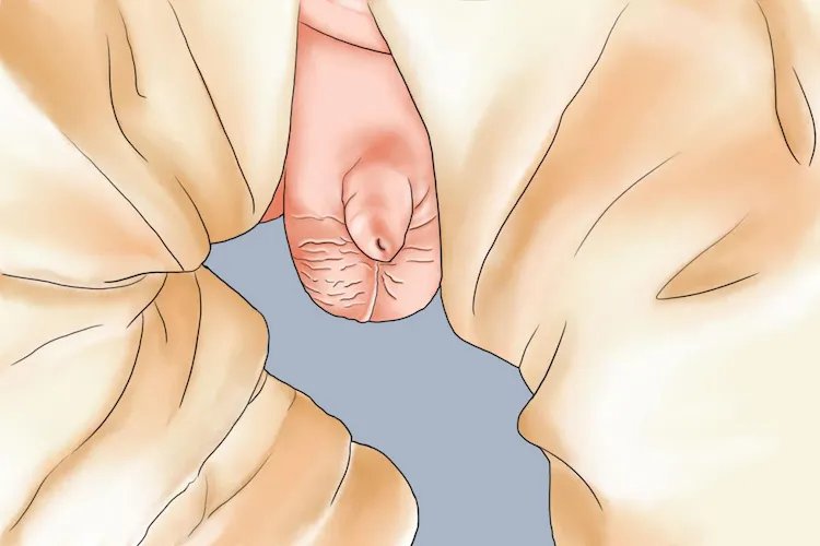 刚出生正常婴儿阴茎图