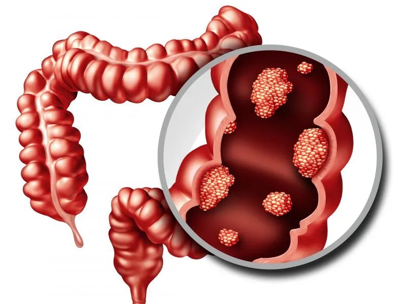 保留灌肠的作用