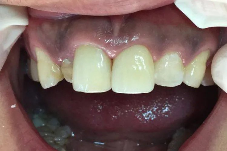 门牙补牙过程图解