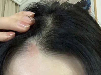 拔毛癖头皮症状图片