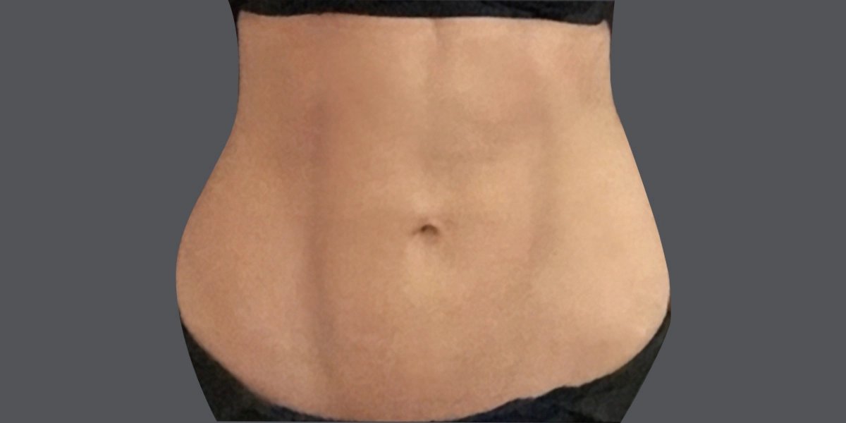 腰腹吸脂凹凸不平图片