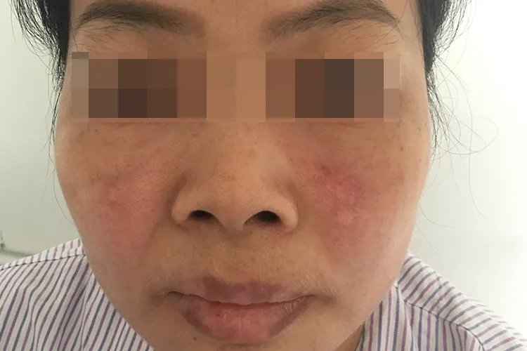 红斑狼疮是什么症状图