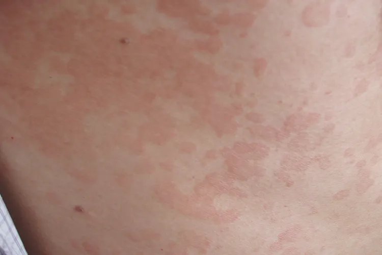 花斑癣图片危害