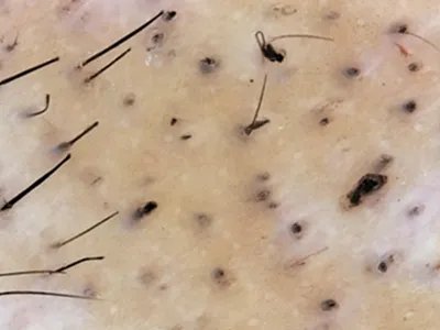 拔毛癖头皮症状图片