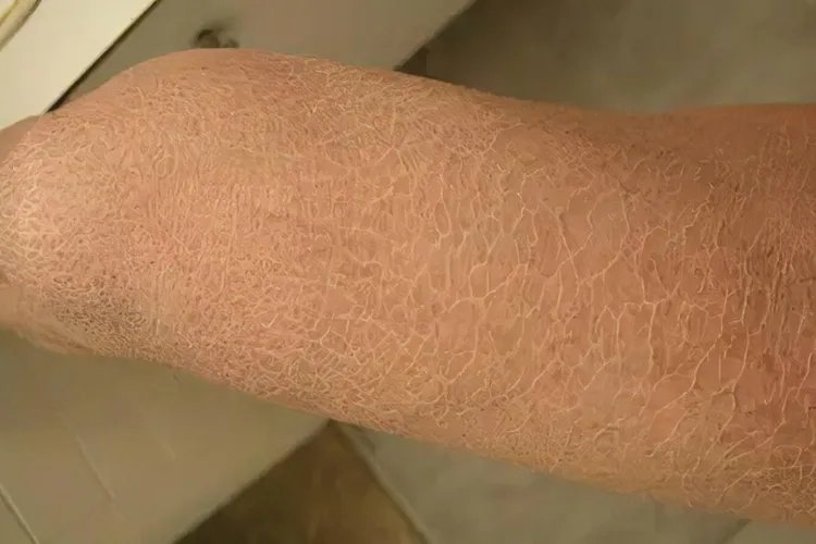 轻度鱼鳞病是什么样子的图片