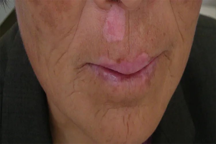 早期白斑症状图片