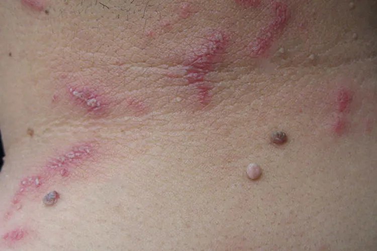 隐翅虫咬人后早期图片