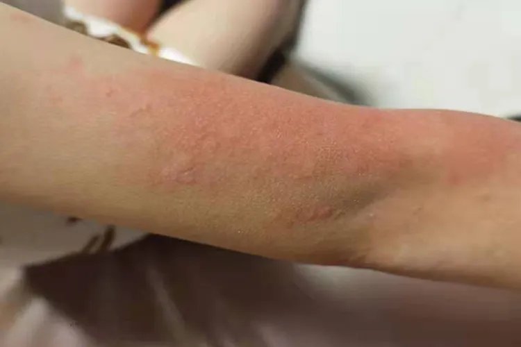 什么是荨麻疹有什么症状图片