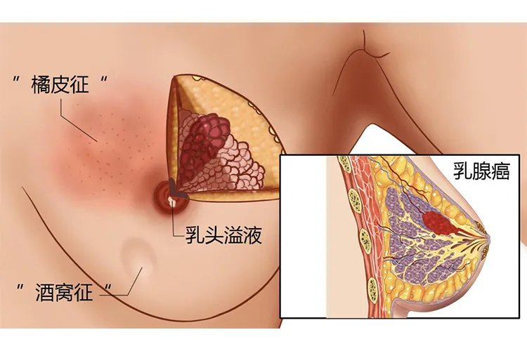 乳腺癌的前期症状是什么样子