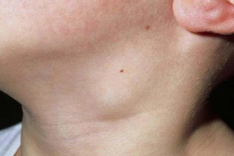 淋巴瘤早期图片大全