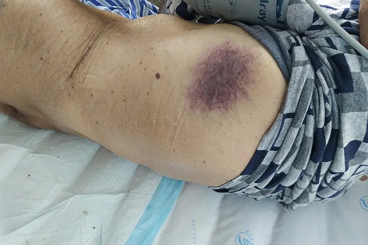 白血病初期针孔小红点图片