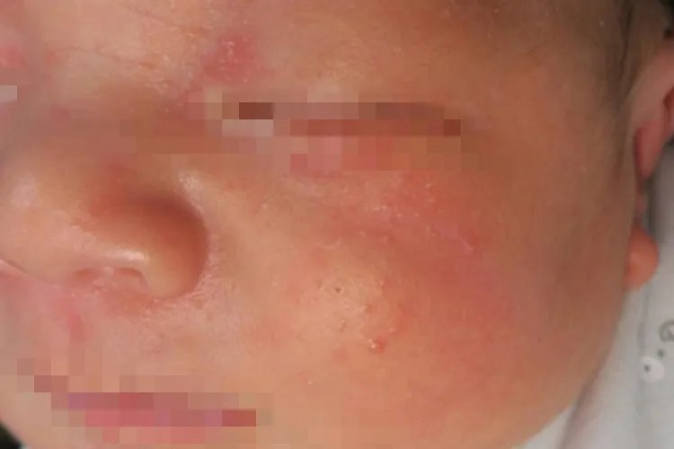 婴儿湿疹图片和症状