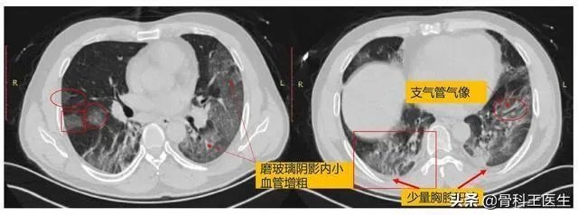 为什么湖北新增病例突增14840例？临床诊断病例是什么？