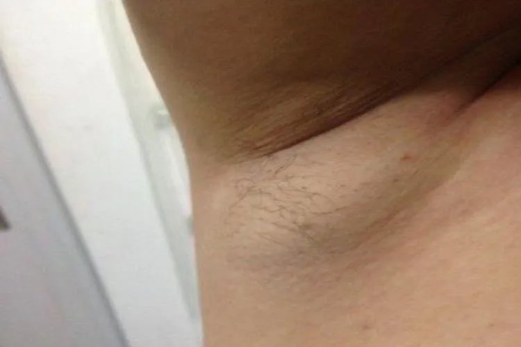 女性腋下淋巴结肿大图