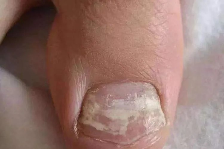 儿童灰指甲图片