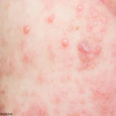 皮带过敏怎么处理