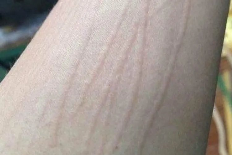 荨麻疹啥样的图片