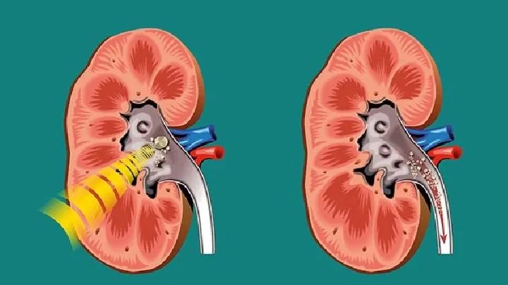 关于肾衰竭能活多久