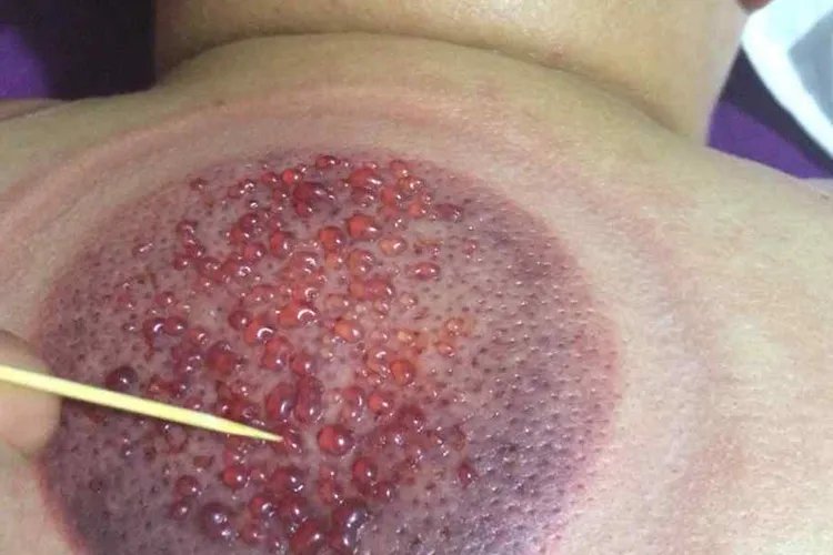 拔罐后湿气重紫黑图片