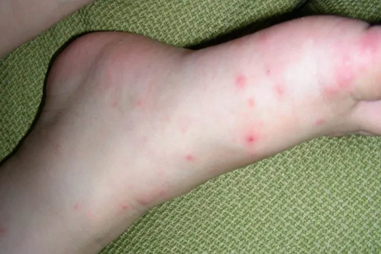 手足口病的初期症状图片