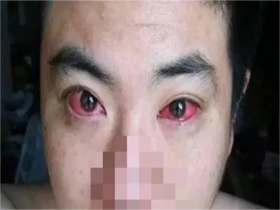 红眼病症状图片