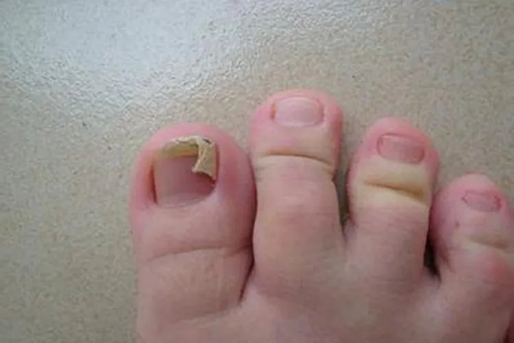 儿童灰指甲图片