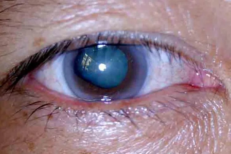 青光眼的早期症状是什么样子