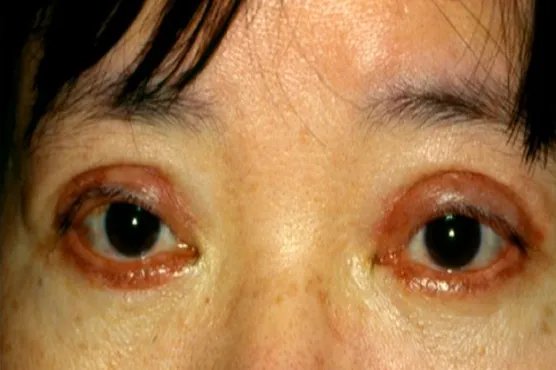 双眼皮离眉毛太近图片