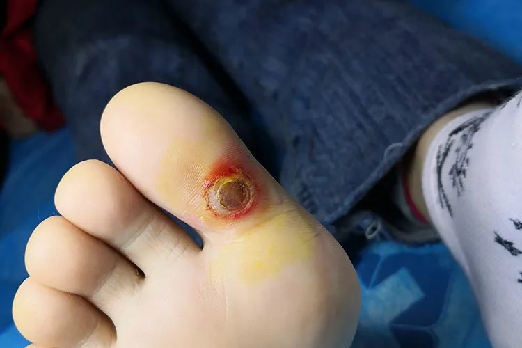 鸡眼图片大全大图