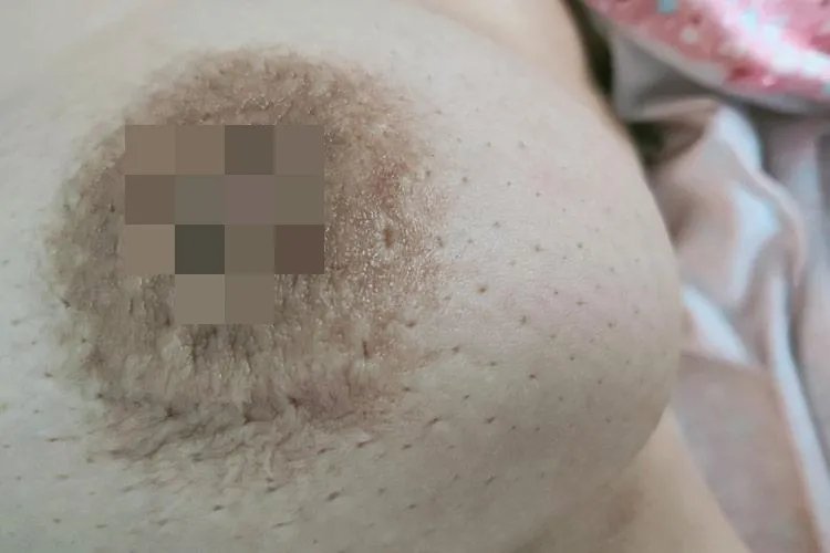 乳腺癌的前期症状是什么样子