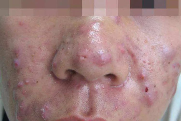 痤疮是什么图片