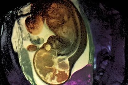 什么是葡萄胎图片，早期症状图片