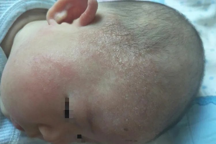 婴儿湿疹图片和症状