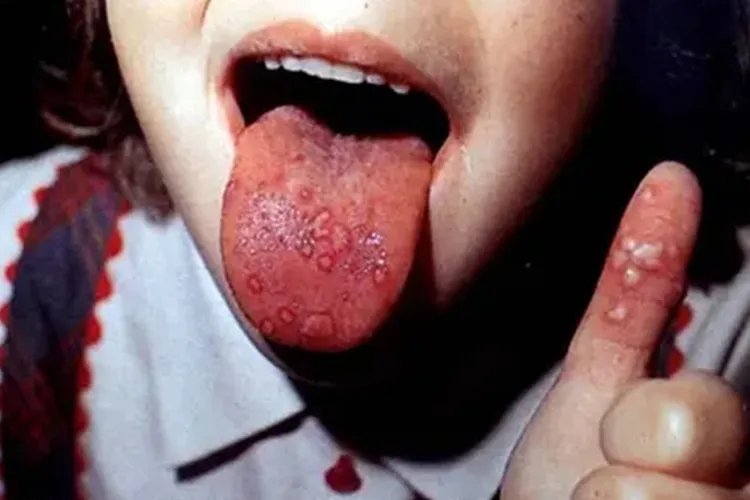 手足口病的特征图片