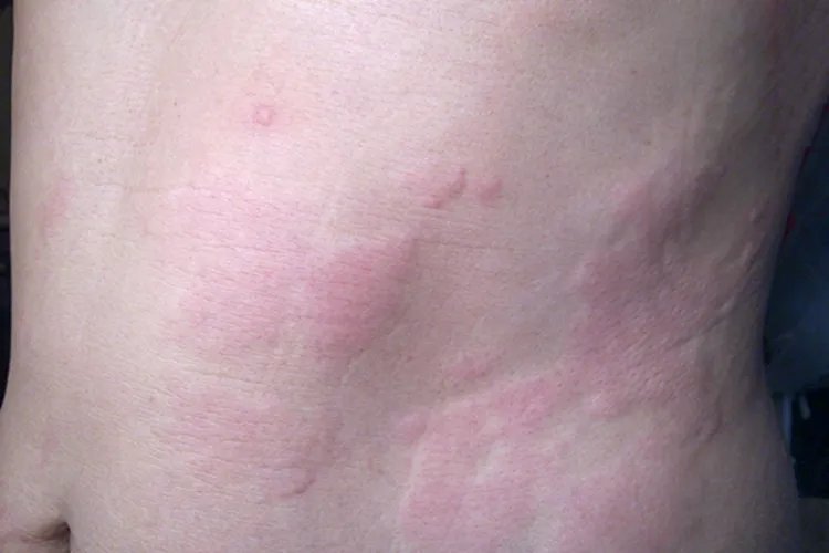 荨麻疹啥样的图片