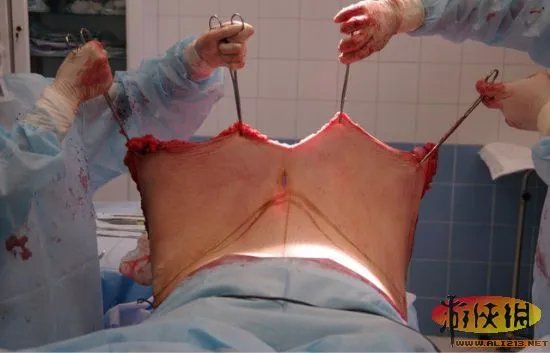 实拍恐怖整形吸脂手术全过程　胆小者慎入！