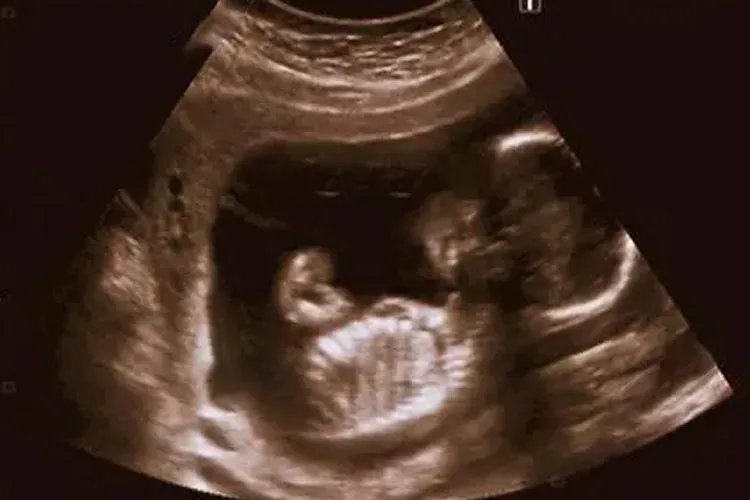 四个月胎儿图片