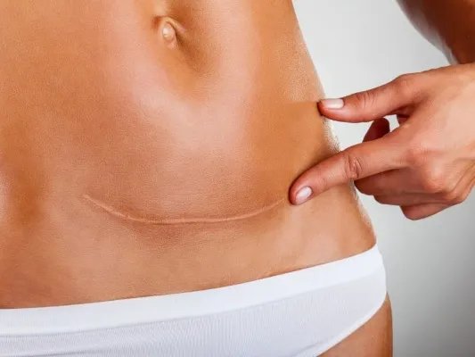 破腹产注意事项