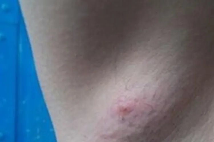 女性腋下淋巴结肿大图