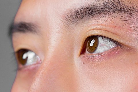 圆锥角膜是什么