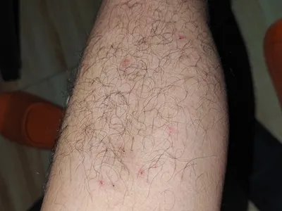 跳蚤叮咬红点图片