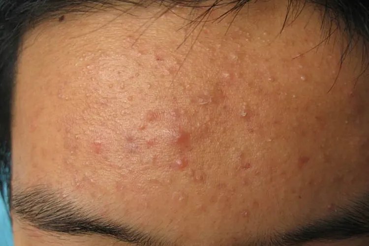 痤疮是什么图片