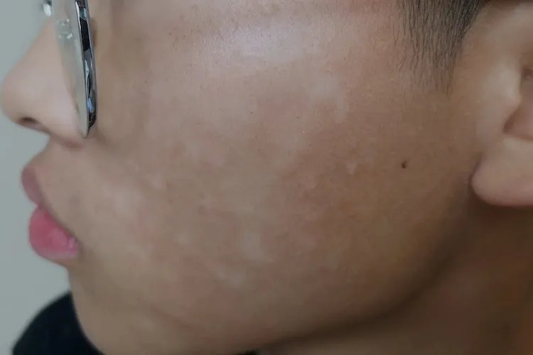 肚子有蛔虫是什么样子的症状