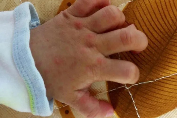 手足口初期早期图片