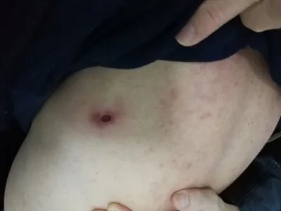 恙虫病焦痂图片